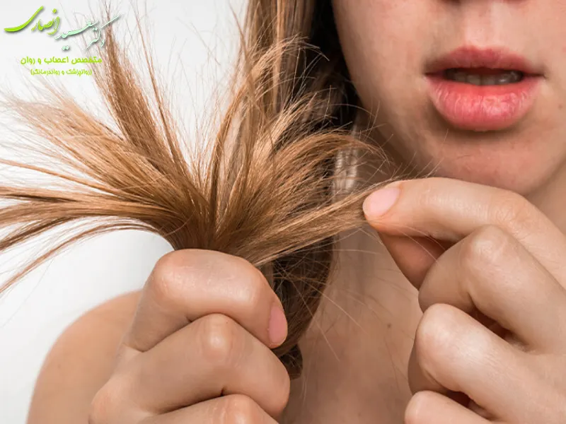 اختلال وسواس مو کندن